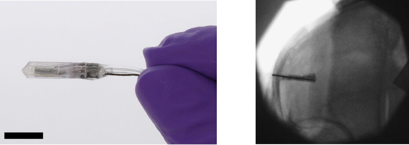 Left: Drug delivery device prototype fabricated by additive manufacturing, parylene C deposition and lamination of freestanding membranes. Scale bar: 1 cm. Right: X-ray of a human cadaveric brain during delivery of a radio contrast agent using my device.